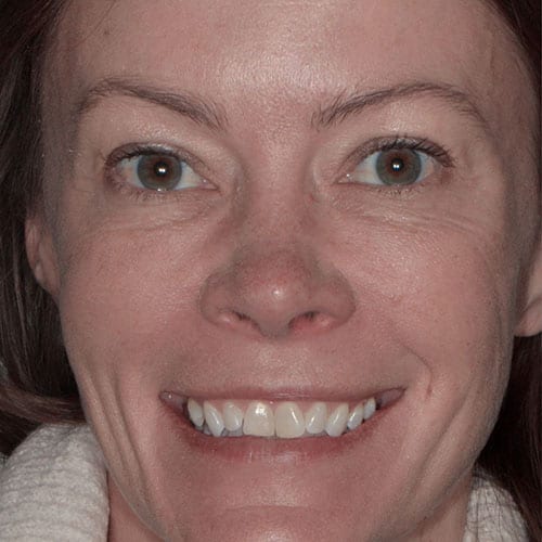 Smile Makeover - Marci - Before